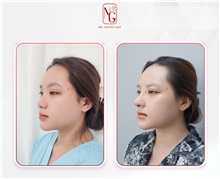 Rhinoplasty After Photo by Tran Nguyen Giap, MD; Phu Nhuan,  - Case 50249