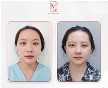 Rhinoplasty Before Photo by Tran Nguyen Giap, MD; Phu Nhuan,  - Case 50249