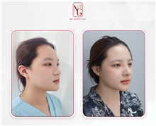 Rhinoplasty After Photo by Tran Nguyen Giap, MD; Phu Nhuan,  - Case 50249