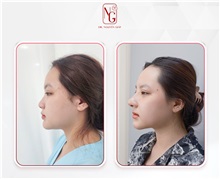 Rhinoplasty Before Photo by Tran Nguyen Giap, MD; Phu Nhuan,  - Case 50249