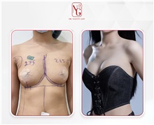 Breast Augmentation After Photo by Tran Nguyen Giap, MD; Phu Nhuan,  - Case 50243