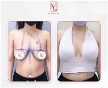 Breast Augmentation Before Photo by Tran Nguyen Giap, MD; Phu Nhuan,  - Case 50243