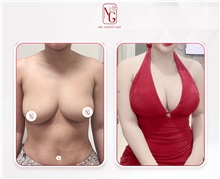 Breast Augmentation After Photo by Tran Nguyen Giap, MD; Phu Nhuan,  - Case 50243