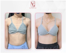 Breast Augmentation Before Photo by Tran Nguyen Giap, MD; Phu Nhuan,  - Case 50243