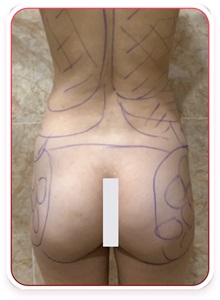 Buttock Lift with Augmentation Before Photo by Tran Nguyen Giap, MD; Phu Nhuan,  - Case 50246