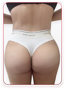 Buttock Lift with Augmentation After Photo by Tran Nguyen Giap, MD; Phu Nhuan,  - Case 50246