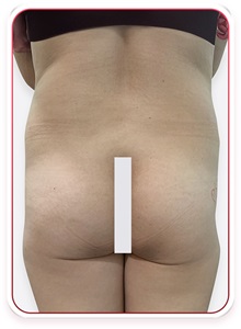 Buttock Lift with Augmentation Before Photo by Tran Nguyen Giap, MD; Phu Nhuan,  - Case 50246