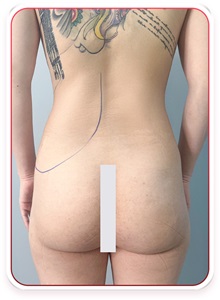 Buttock Lift with Augmentation Before Photo by Tran Nguyen Giap, MD; Phu Nhuan,  - Case 50246