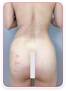 Buttock Lift with Augmentation Before Photo by Tran Nguyen Giap, MD; Phu Nhuan,  - Case 50246
