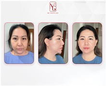 Facial Feminization After Photo by Tran Nguyen Giap, MD; Phu Nhuan,  - Case 50247