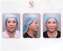 Facial Feminization Before Photo by Tran Nguyen Giap, MD; Phu Nhuan,  - Case 50247