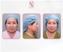 Facial Feminization After Photo by Tran Nguyen Giap, MD; Phu Nhuan,  - Case 50247