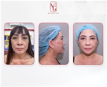 Facial Feminization Before Photo by Tran Nguyen Giap, MD; Phu Nhuan,  - Case 50247