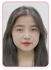 Rhinoplasty After Photo by Tran Nguyen Giap, MD; Phu Nhuan,  - Case 50252