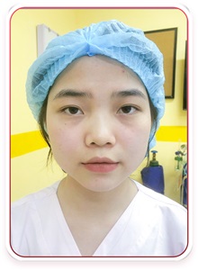 Rhinoplasty Before Photo by Tran Nguyen Giap, MD; Phu Nhuan,  - Case 50252