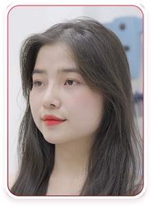 Rhinoplasty After Photo by Tran Nguyen Giap, MD; Phu Nhuan,  - Case 50252