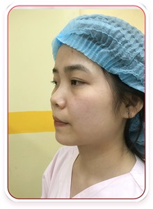 Rhinoplasty Before Photo by Tran Nguyen Giap, MD; Phu Nhuan,  - Case 50252
