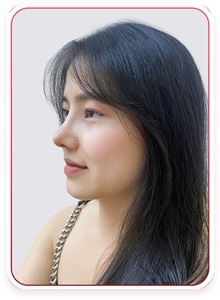 Rhinoplasty After Photo by Tran Nguyen Giap, MD; Phu Nhuan,  - Case 50252