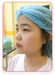 Rhinoplasty Before Photo by Tran Nguyen Giap, MD; Phu Nhuan,  - Case 50252