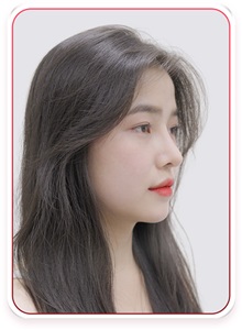 Rhinoplasty After Photo by Tran Nguyen Giap, MD; Phu Nhuan,  - Case 50252