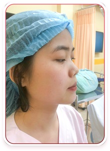 Rhinoplasty Before Photo by Tran Nguyen Giap, MD; Phu Nhuan,  - Case 50252