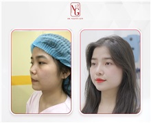 Rhinoplasty After Photo by Tran Nguyen Giap, MD; Phu Nhuan,  - Case 50252
