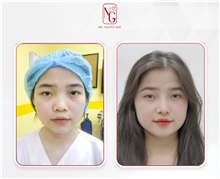 Rhinoplasty Before Photo by Tran Nguyen Giap, MD; Phu Nhuan,  - Case 50252