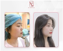 Rhinoplasty After Photo by Tran Nguyen Giap, MD; Phu Nhuan,  - Case 50252