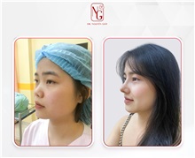 Rhinoplasty Before Photo by Tran Nguyen Giap, MD; Phu Nhuan,  - Case 50252