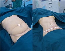 Body Contouring After Photo by Tran Nguyen Giap, MD; Phu Nhuan,  - Case 50253
