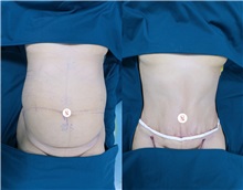 Body Contouring Before Photo by Tran Nguyen Giap, MD; Phu Nhuan,  - Case 50253
