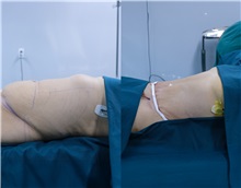 Body Contouring After Photo by Tran Nguyen Giap, MD; Phu Nhuan,  - Case 50253
