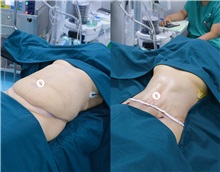 Body Contouring Before Photo by Tran Nguyen Giap, MD; Phu Nhuan,  - Case 50253