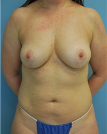 Breast Lift After Photo by Aldona Spiegel, MD; Houston, TX - Case 46257