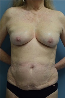 Breast Implant Revision After Photo by Aldona Spiegel, MD; Houston, TX - Case 46259