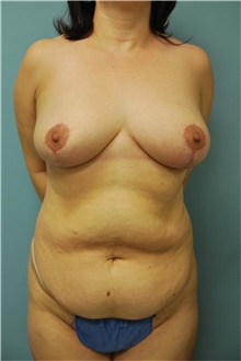 Breast Reduction After Photo by Aldona Spiegel, MD; Houston, TX - Case 46261