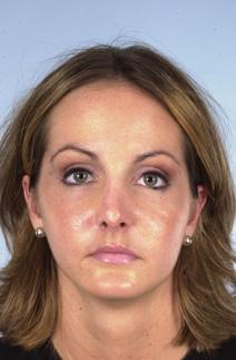 Rhinoplasty After Photo by Scott Spear, MD, FACS; Chevy Chase, MD - Case 6802