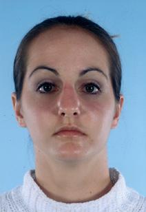 Rhinoplasty Before Photo by Scott Spear, MD, FACS; Chevy Chase, MD - Case 6802