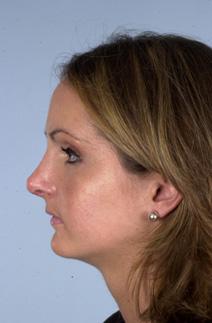 Rhinoplasty After Photo by Scott Spear, MD, FACS; Chevy Chase, MD - Case 6802