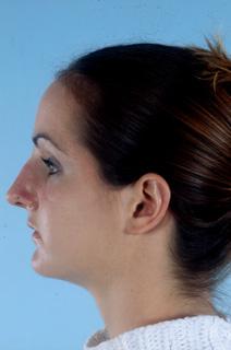 Rhinoplasty Before Photo by Scott Spear, MD, FACS; Chevy Chase, MD - Case 6802