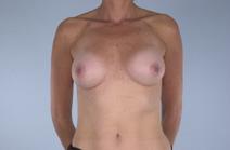 Breast Augmentation After Photo by Scott Spear, MD, FACS; Chevy Chase, MD - Case 6805