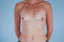Breast Augmentation Before Photo by Scott Spear, MD, FACS; Chevy Chase, MD - Case 6805