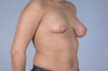 Breast Augmentation Before Photo by Scott Spear, MD, FACS; Chevy Chase, MD - Case 6807