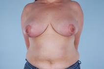 Breast Reduction After Photo by Scott Spear, MD, FACS; Chevy Chase, MD - Case 6839