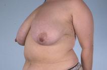 Breast Reduction Before Photo by Scott Spear, MD, FACS; Chevy Chase, MD - Case 6839