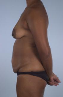 Tummy Tuck Before Photo by Scott Spear, MD, FACS; Chevy Chase, MD - Case 6947