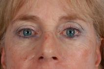 Eyelid Surgery After Photo by Scott Spear, MD, FACS; Chevy Chase, MD - Case 7098