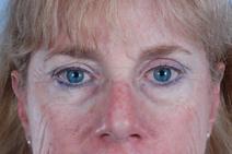 Eyelid Surgery Before Photo by Scott Spear, MD, FACS; Chevy Chase, MD - Case 7098