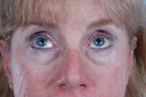 Eyelid Surgery Before Photo by Scott Spear, MD, FACS; Chevy Chase, MD - Case 7098