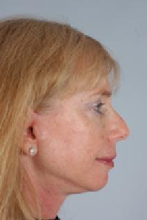 Facelift After Photo by Scott Spear, MD, FACS; Chevy Chase, MD - Case 7099